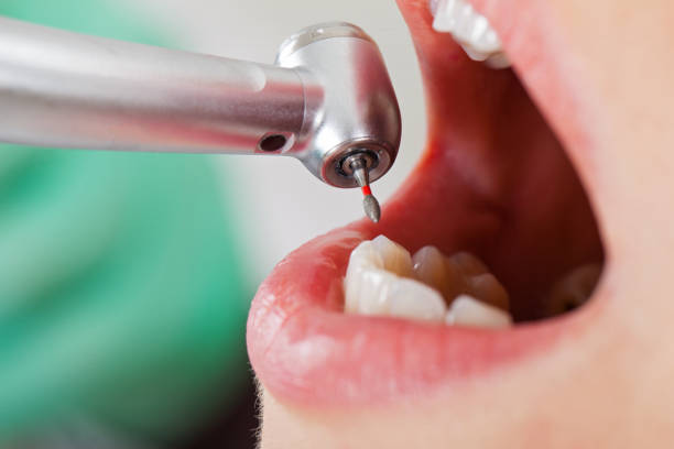 Best Emergency Dental Extractions in Mazon, IL